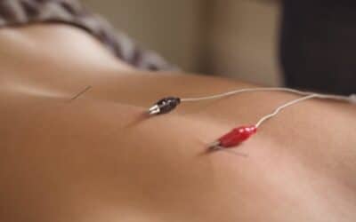 The Stimulating Benefits of Electro-Acupuncture