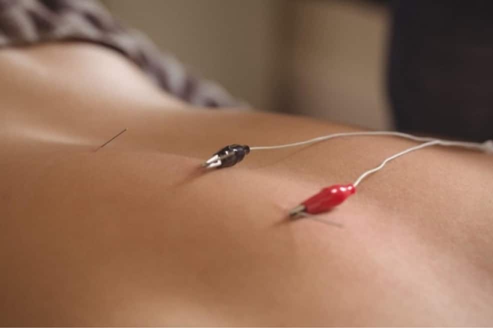 The Stimulating Benefits of Electro-Acupuncture